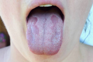 Quelles sont les principales causes d’une langue blanche malodorante et comment y remedier ?