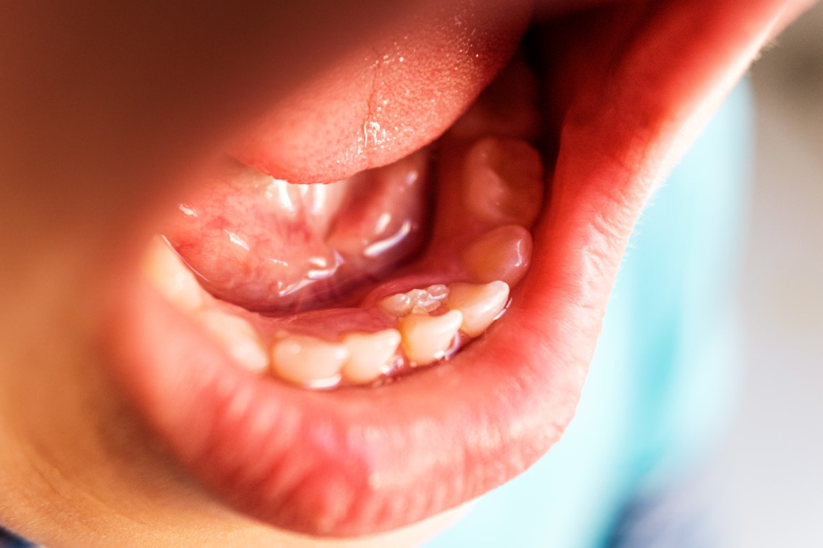 Langue qui brule en medecine chinoise